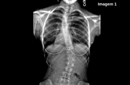 Pilates vs Escoliose