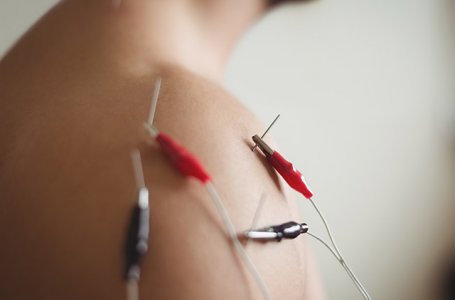 Eletropuntura no tratamento da tendinopatia com calcificao: reflexo sobre um estudo piloto