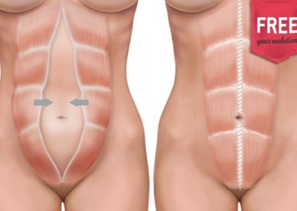 Como avaliar a parede abdominal no ps-parto? Tutorial com Eunice Moura