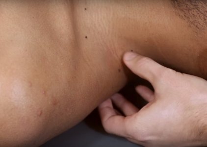 Tutorial tratamento de Trigger Point: Compresso Isqumica no trapzio superior (vdeo e ebook)